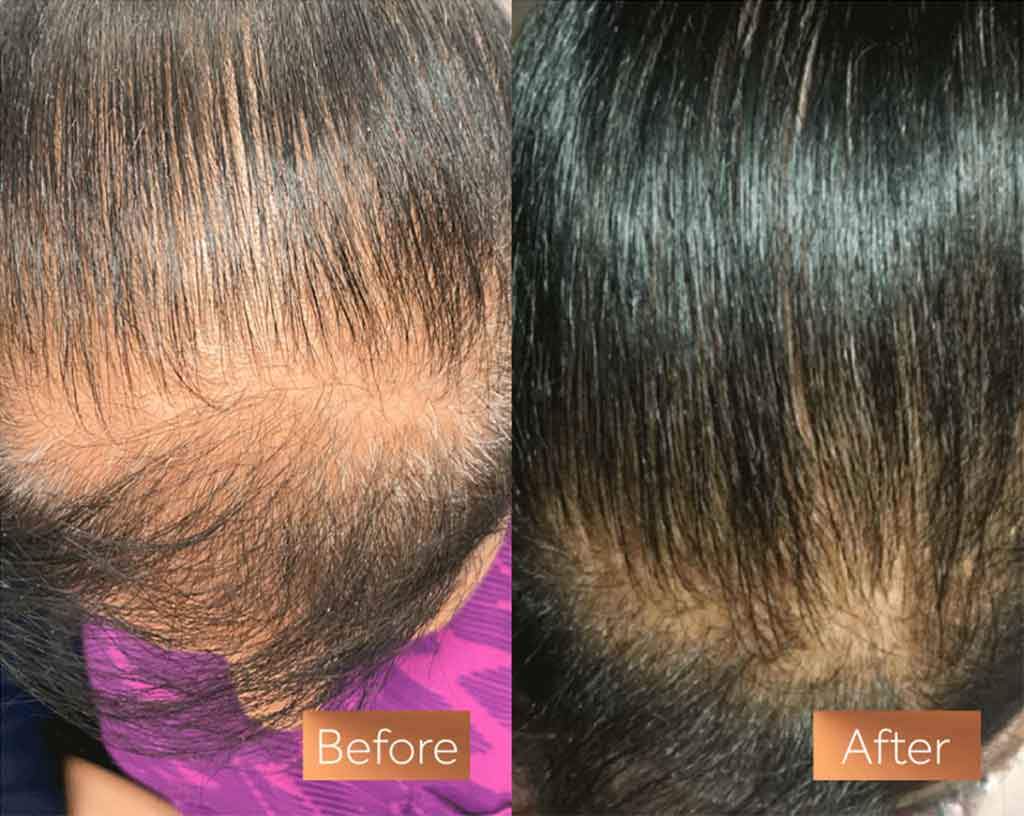 Collagen and Hair Loss
