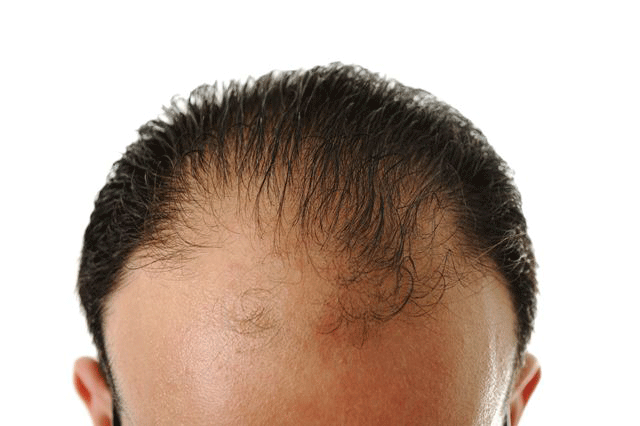 Thinning Hair – Causes and Treatment